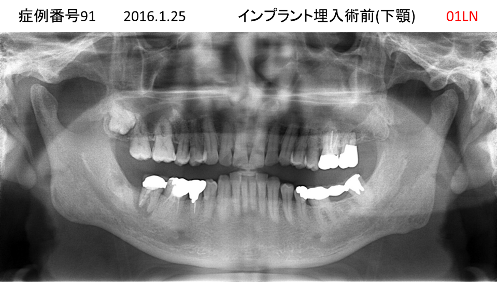 インプラント治療前