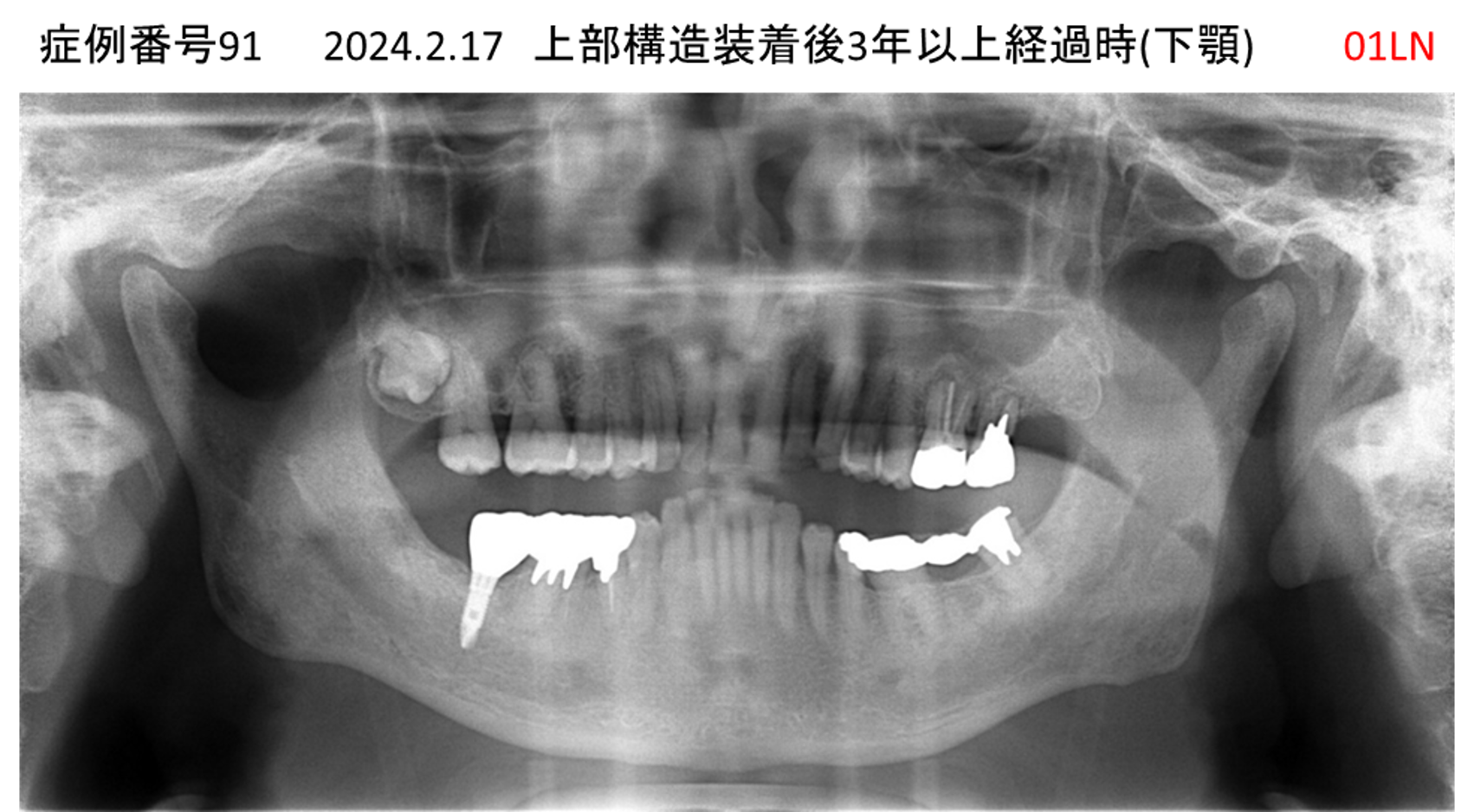インプラント治療後