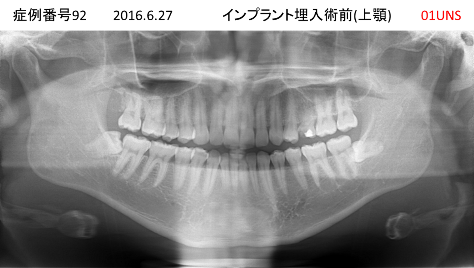 インプラント治療前