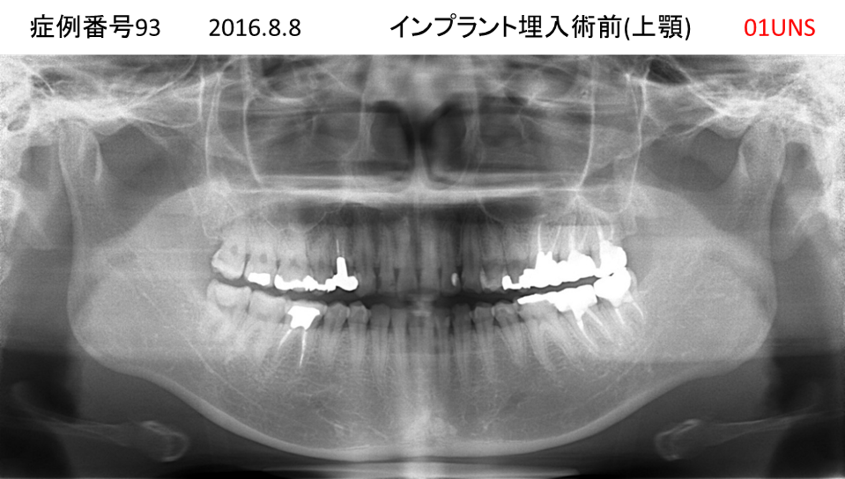 インプラント治療前