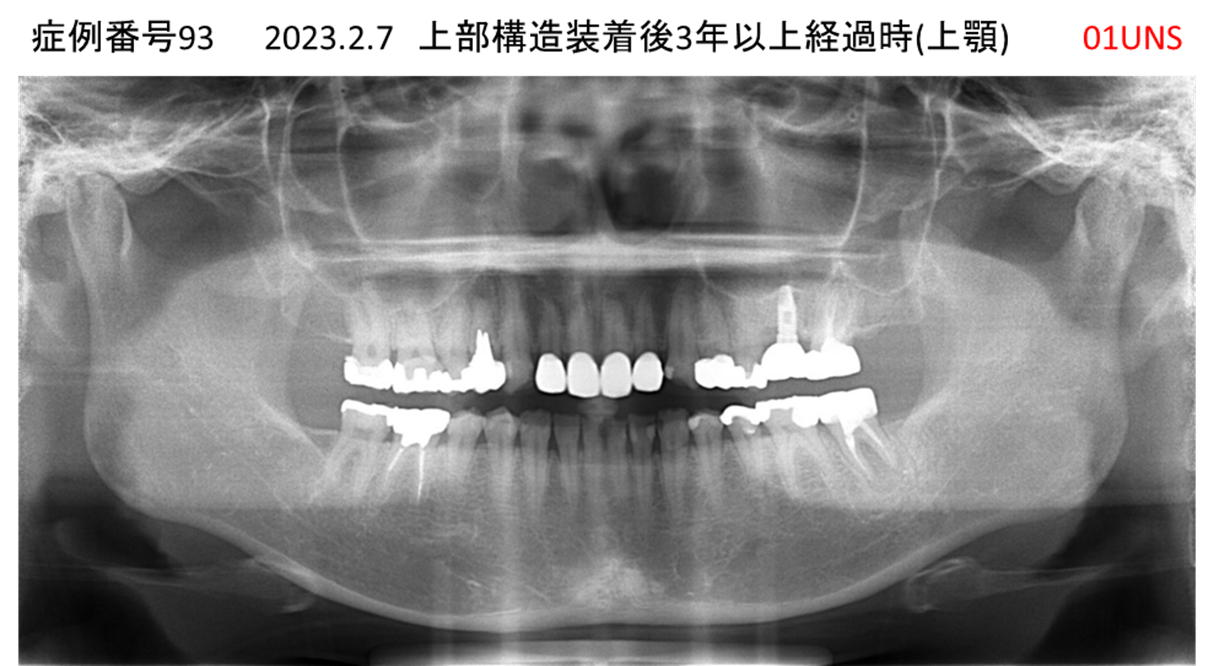 インプラント治療後