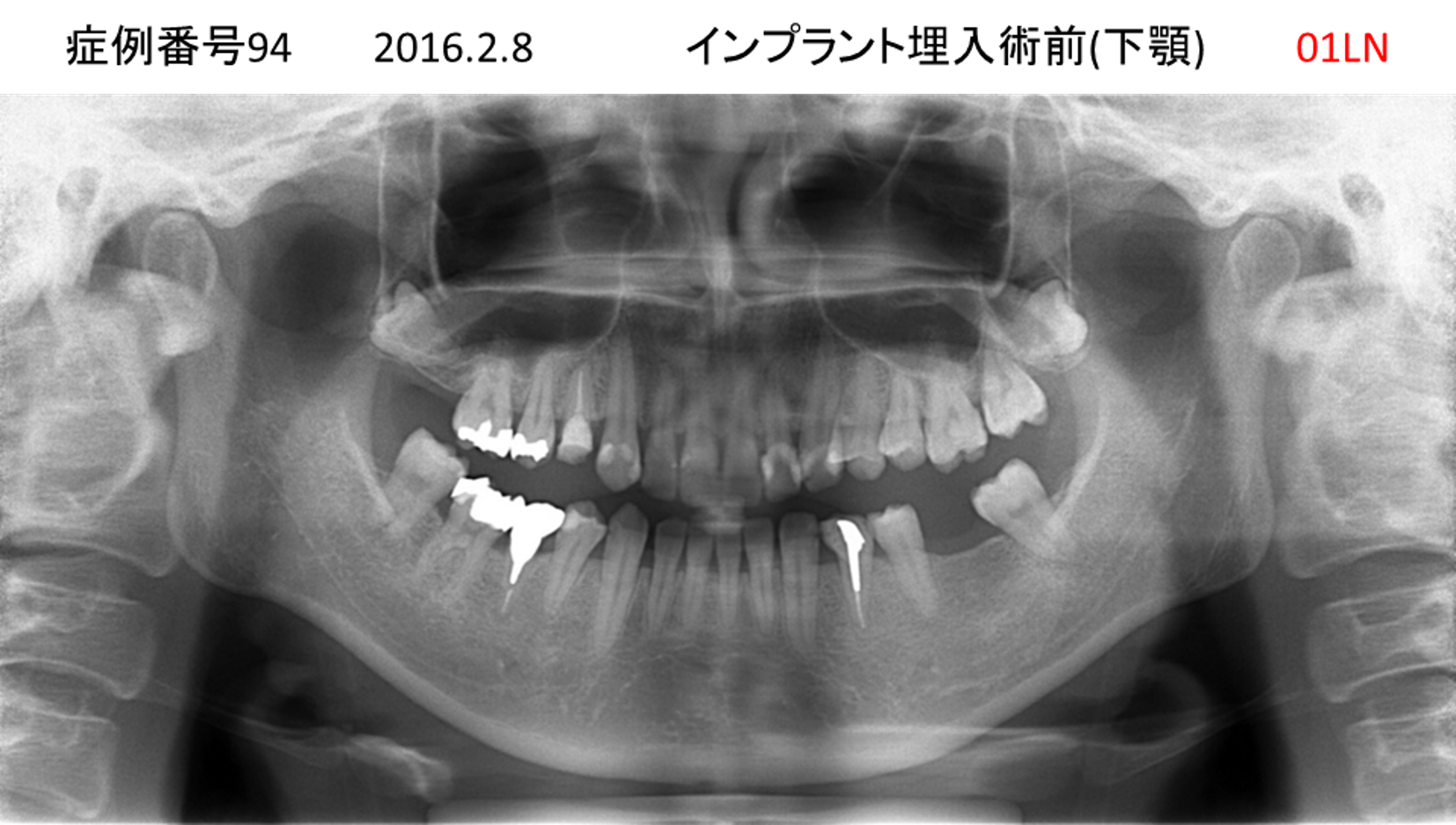 インプラント治療前