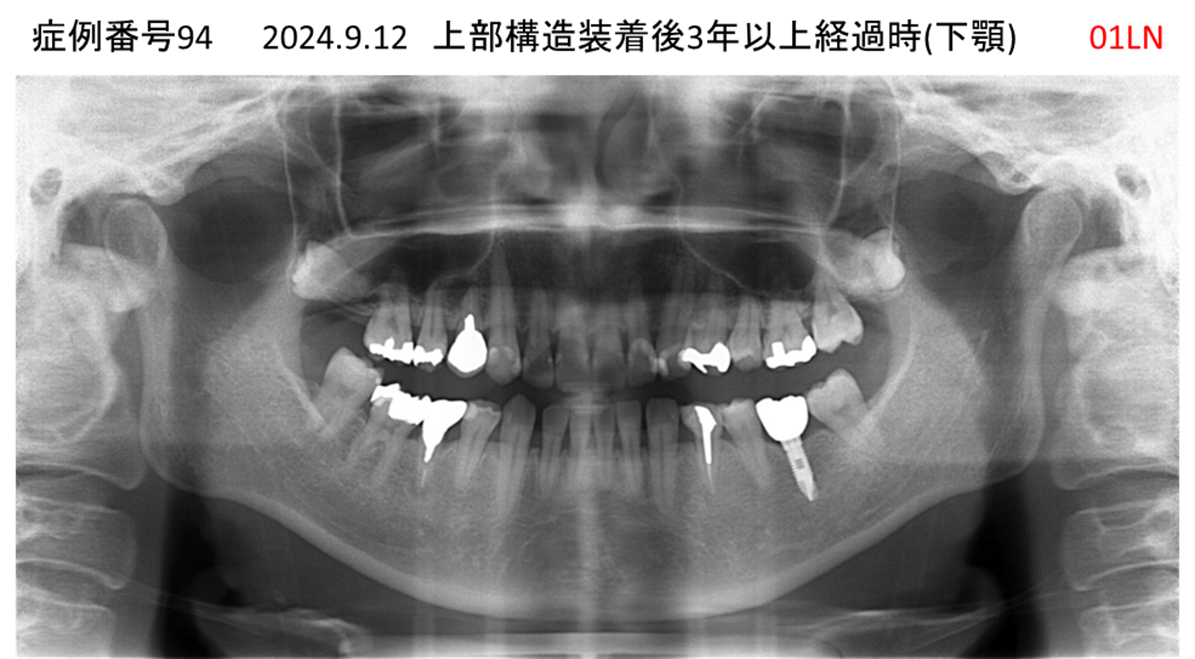 インプラント治療後