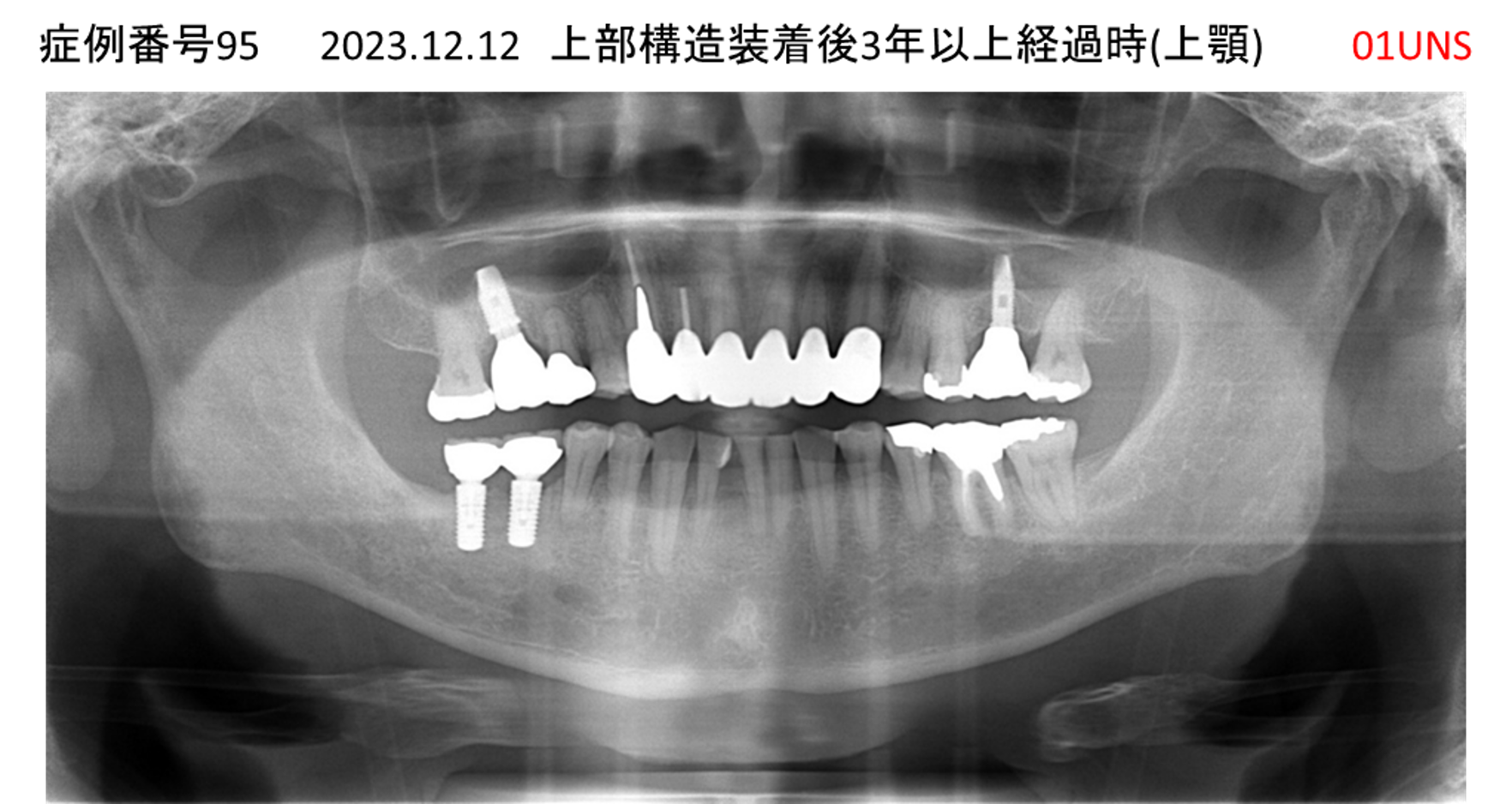 インプラント治療後
