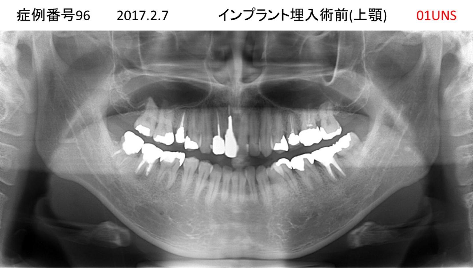 インプラント治療前