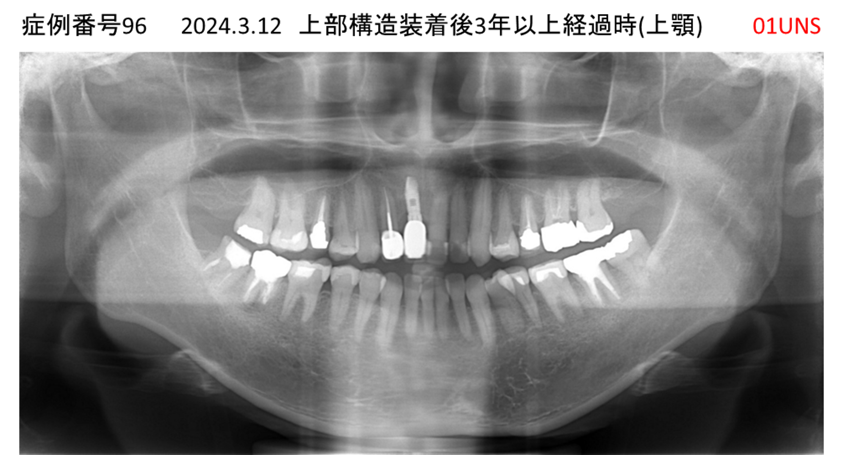 インプラント治療後