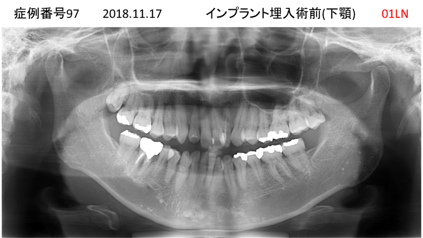インプラント治療前