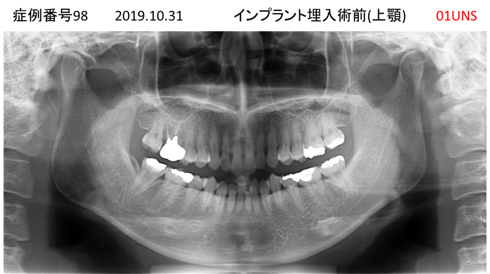 インプラント治療前