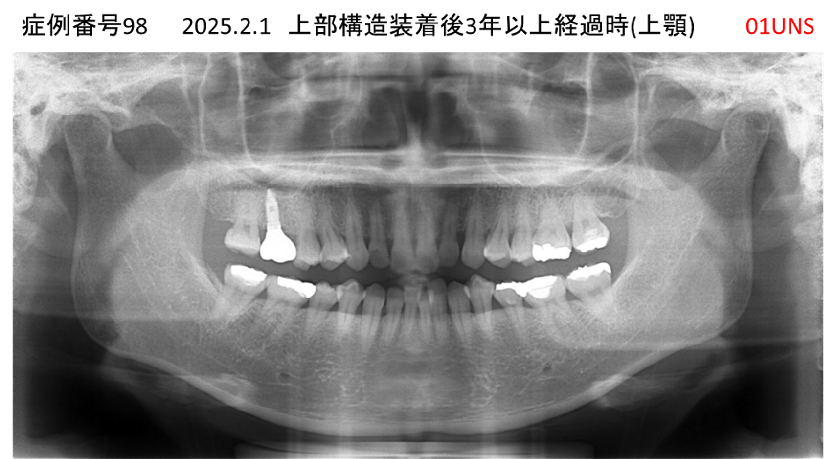 インプラント治療後