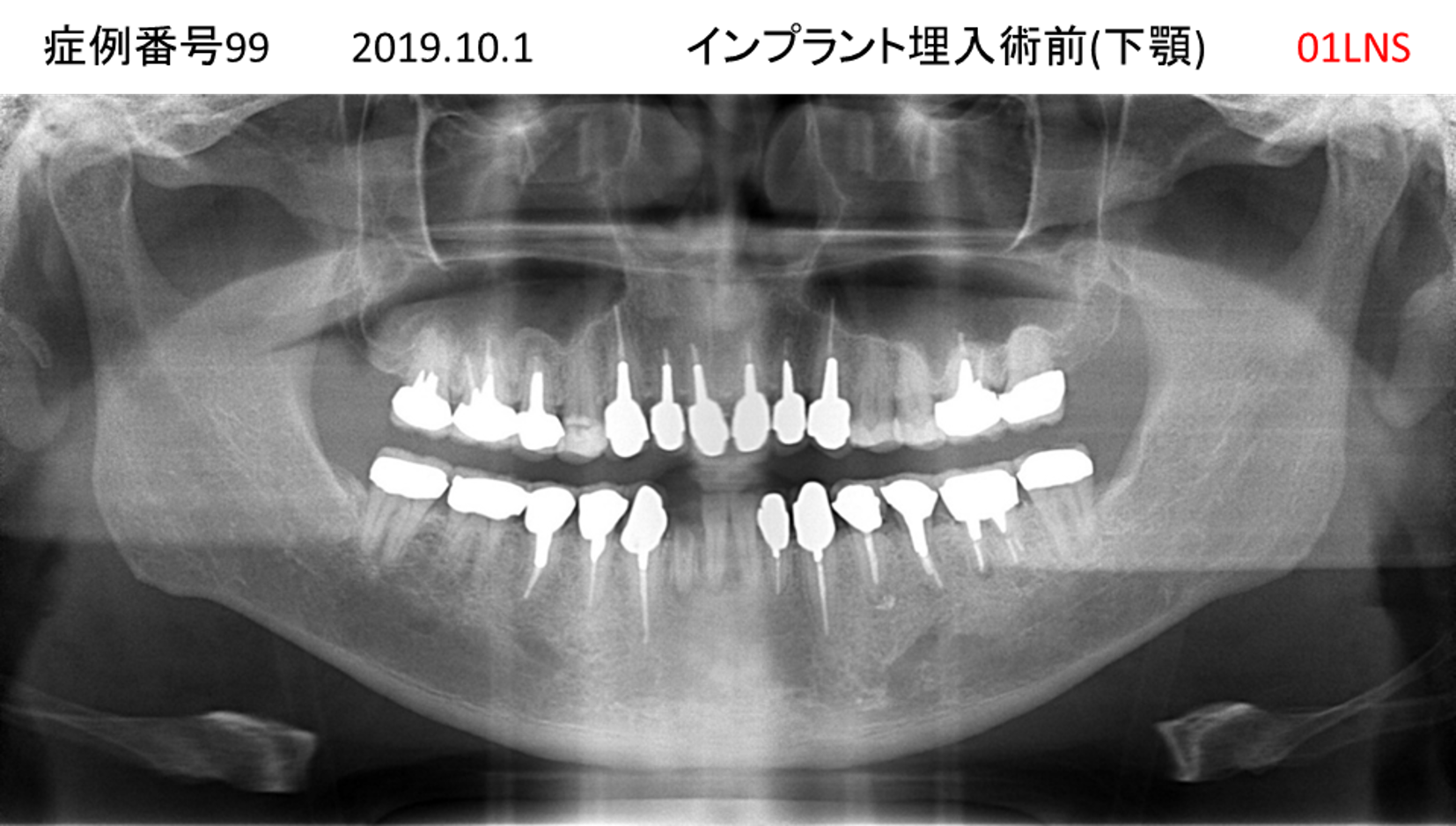 インプラント治療前