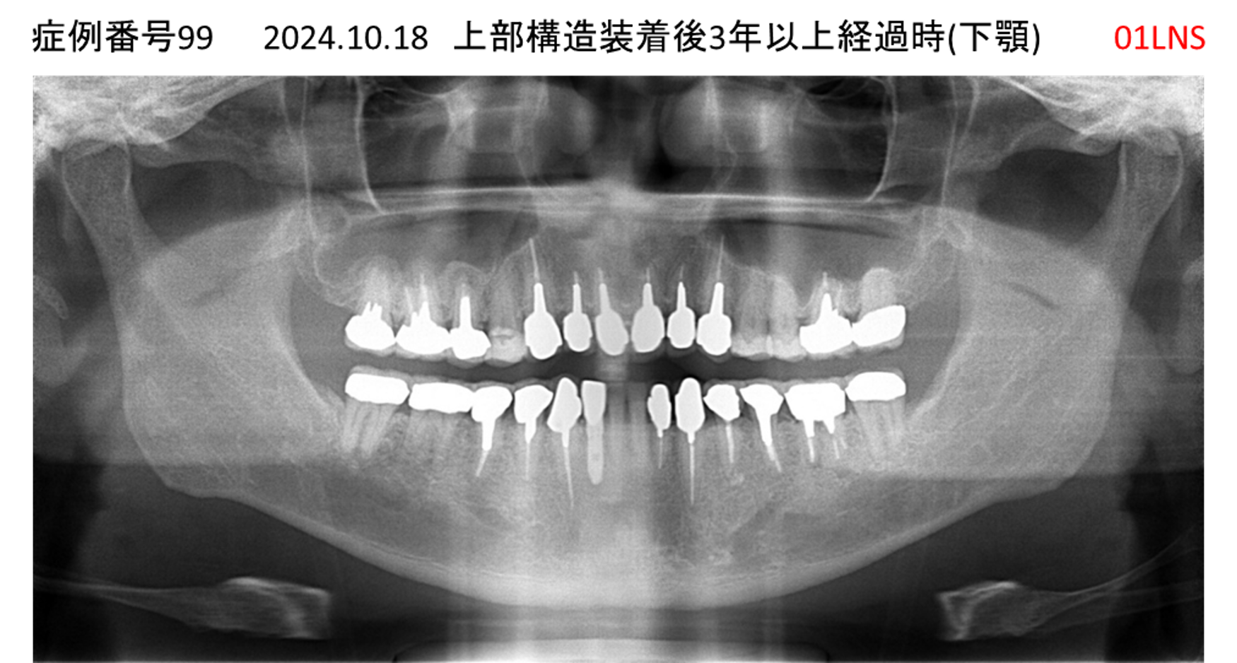 インプラント治療後
