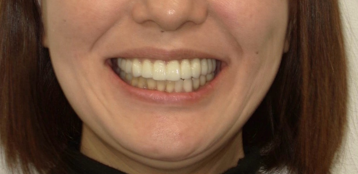 インプラント治療後