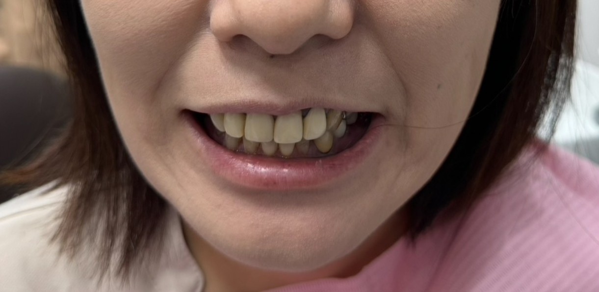 インプラント治療前