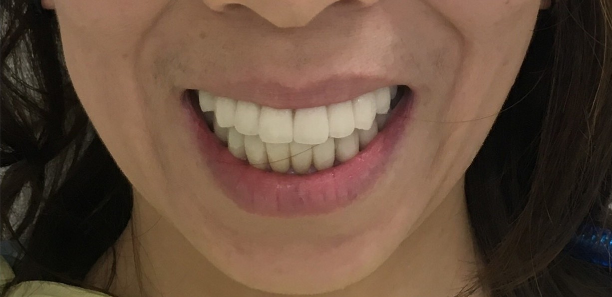 インプラント治療後