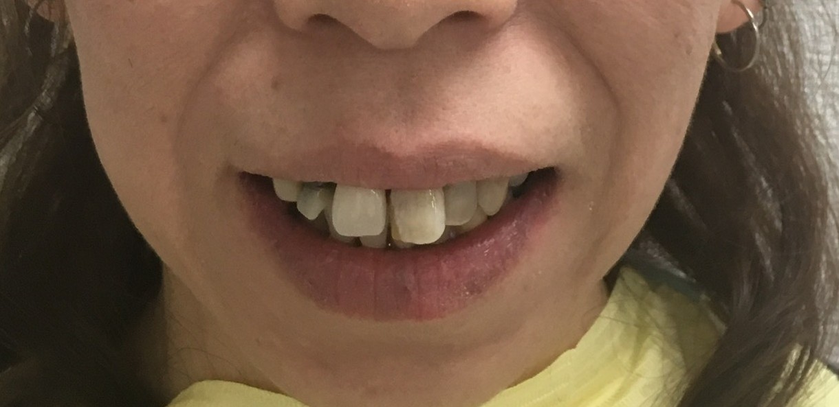 インプラント治療前