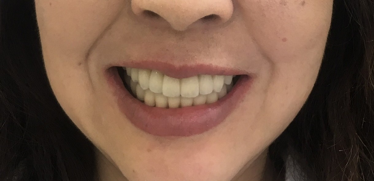 インプラント治療後