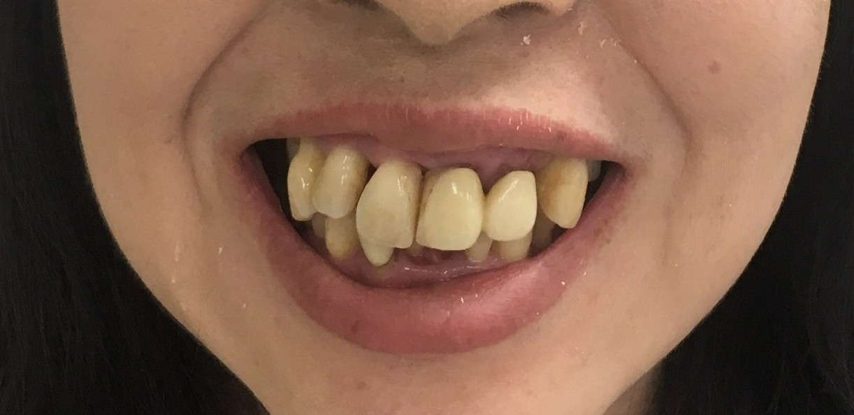 インプラント治療前