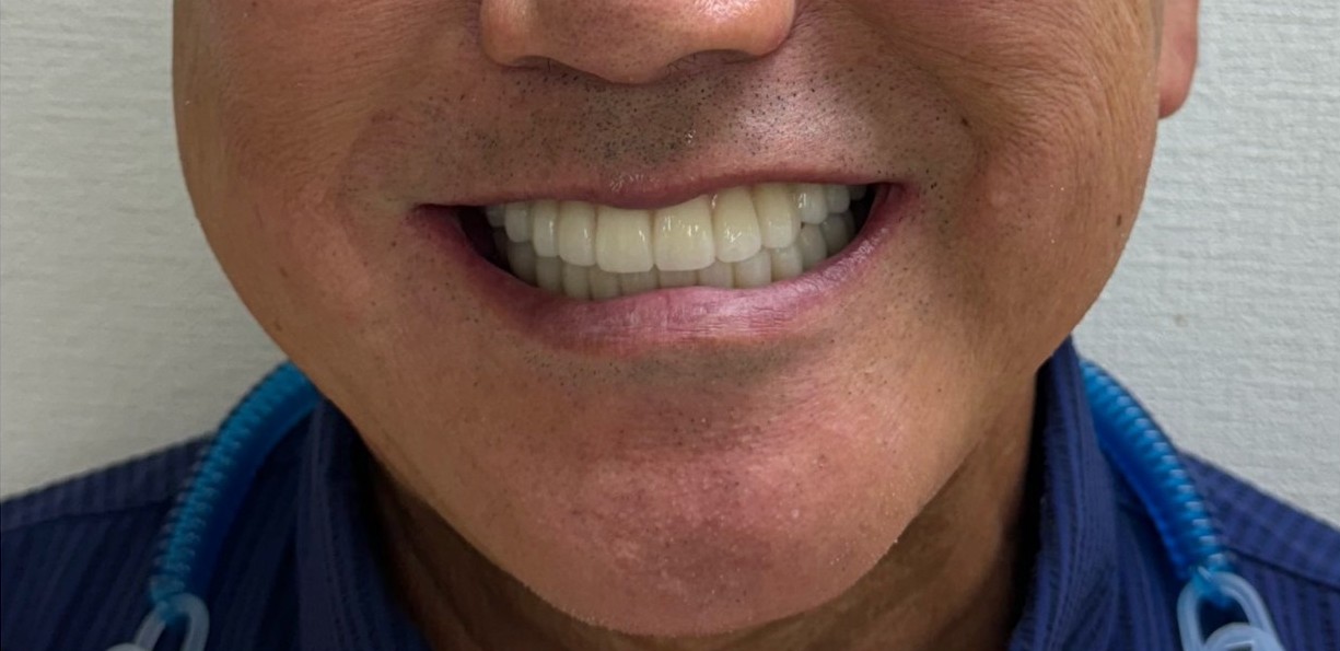 インプラント治療後