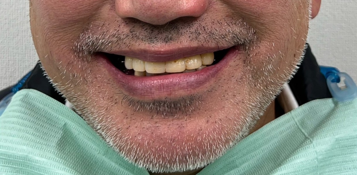 インプラント治療前