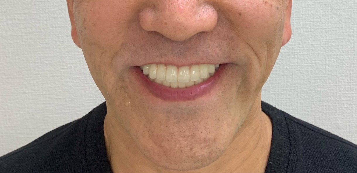 インプラント治療後