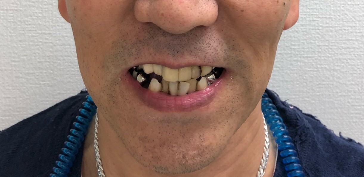 インプラント治療前