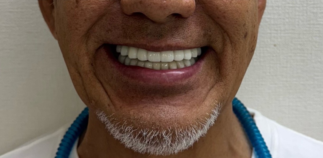 インプラント治療後