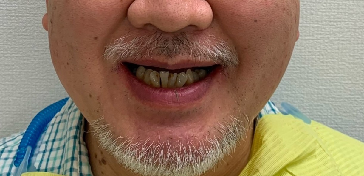 インプラント治療前