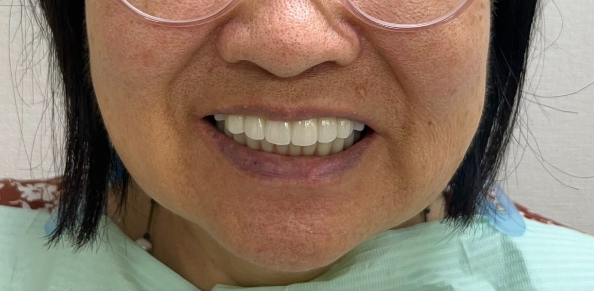 インプラント治療後