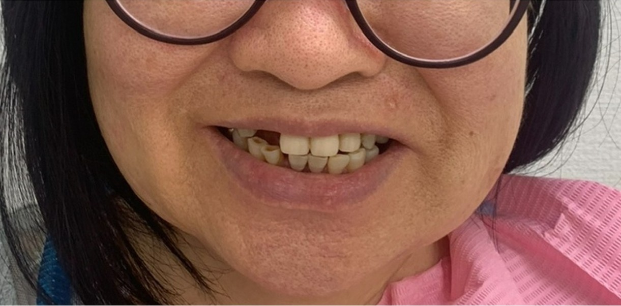 インプラント治療前