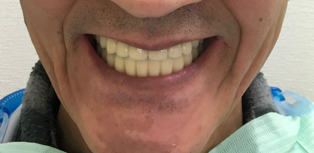 インプラント治療後