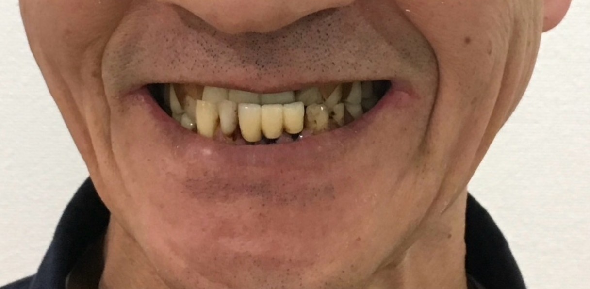 インプラント治療前