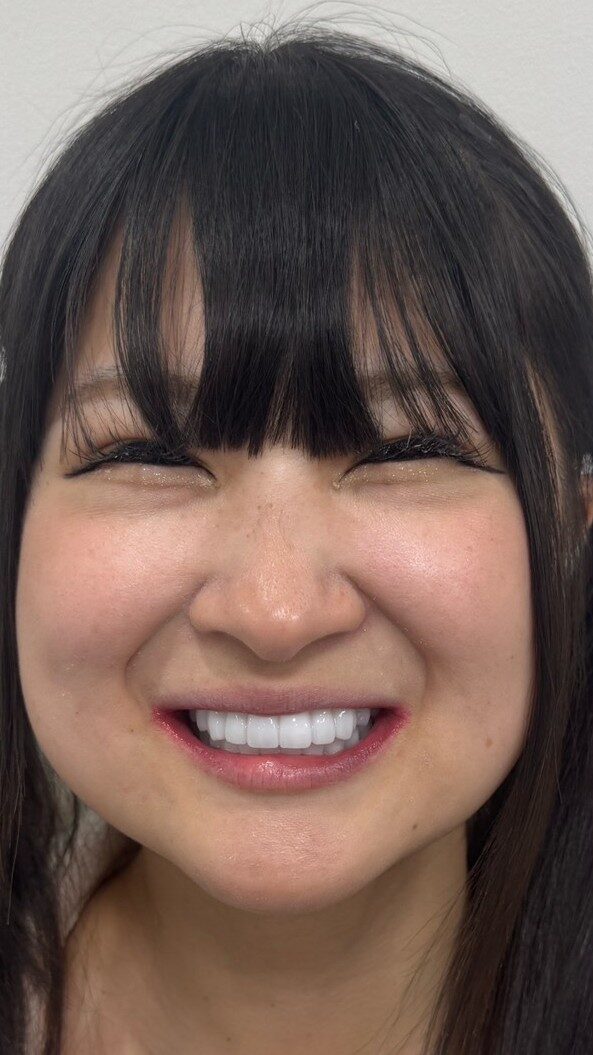 インプラント治療後