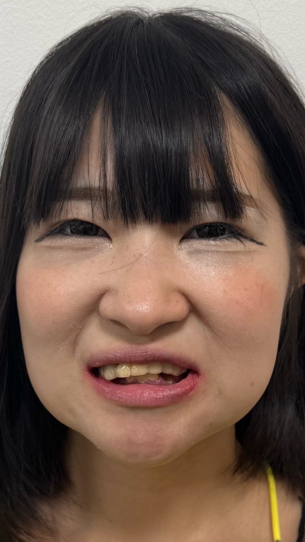 インプラント治療前